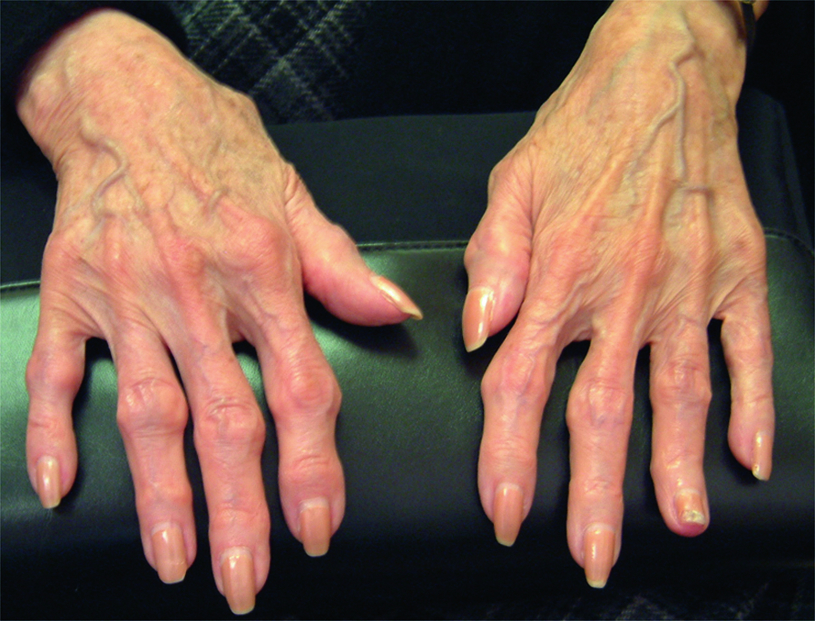Остеоартроз пальцев рук