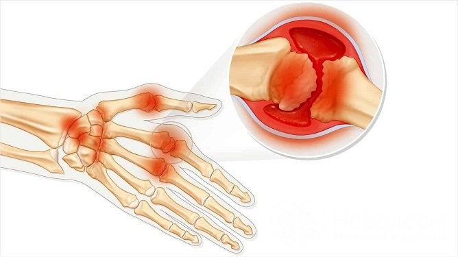 При полиартрите пальцев рук в патологический процесс вовлекается 4 и более сустава