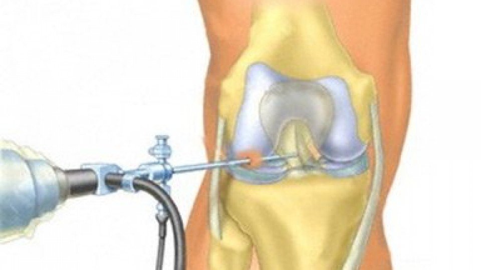 Артроскопическая операция на колене