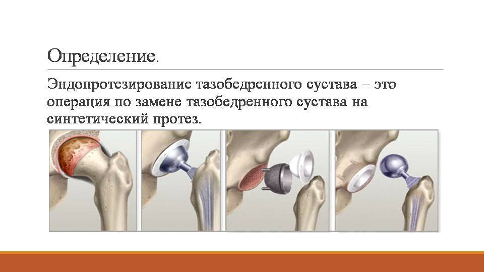 Схема протеза