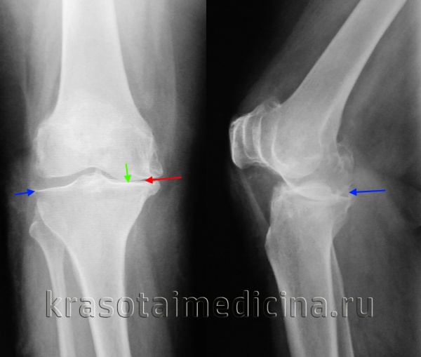 Рентгенография коленного сустава. Деформирующий гонартроз. Сужение суставной щели (красная стрелка), остеофиты (синяя стрелка), остеосклероз суставных поверхностей (зеленая стрелка).