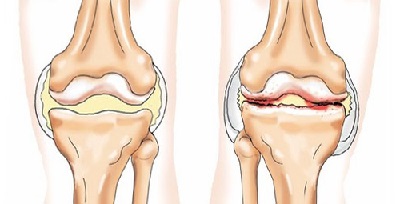 Гонартроз 2 3 степени коленного сустава лечение