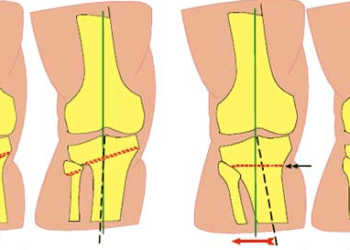 Корригирующая остеотомия коленного сустава: показания, виды операции и реабилитация
