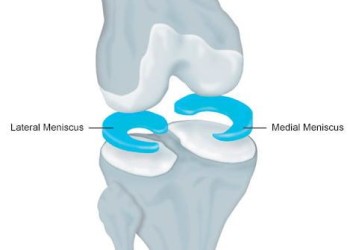 Хирургия и последующая реабилитация мениска коленного сустава