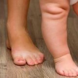 Лечение вальгусной стопы у ребенка   