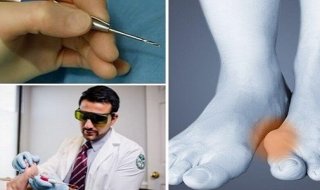 Операции по удалению косточки на большом пальце ноги  
