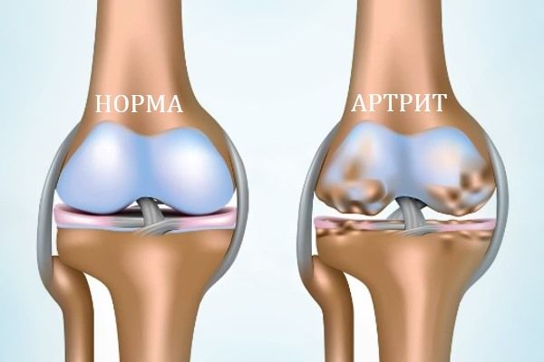 Острый артрит коленного сустава: причины, симптомы, диагностика, лечение