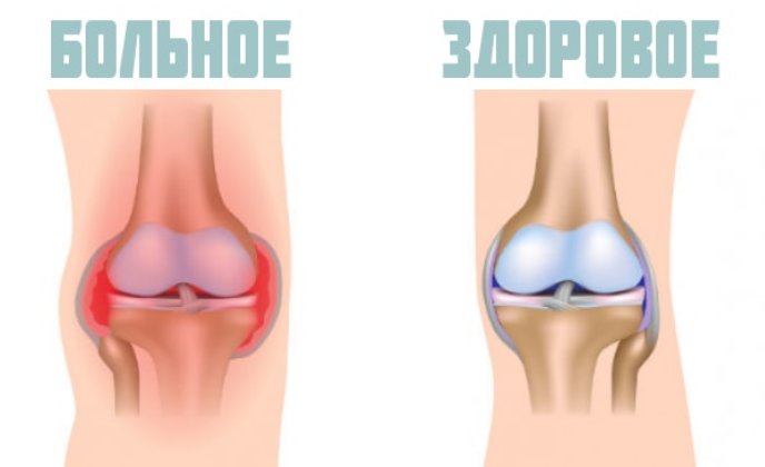 Гемартроз коленного сустава – лечение, симптомы, диагностика и профилактика