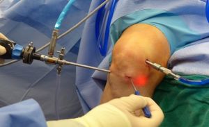 Артроскопия на коленном суставе