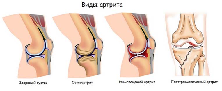 Причины и симптомы воспаленного коленного сустава