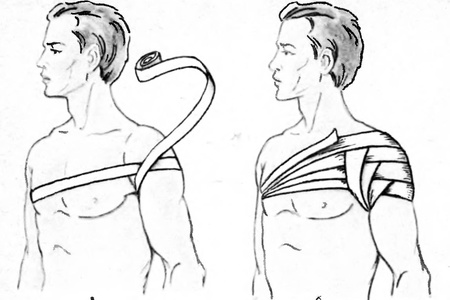 Колосовидная повязка на плечевой сустав: как использовать