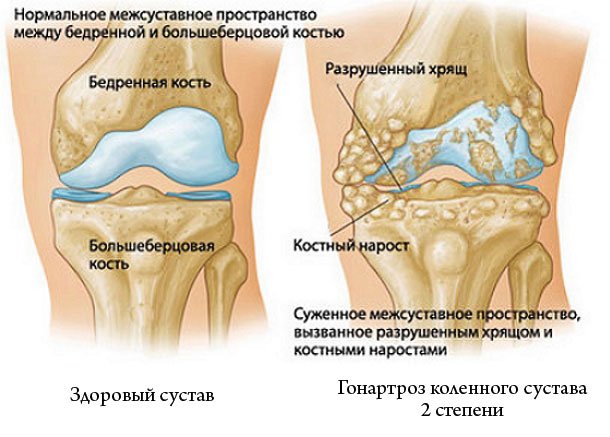 Эта болезнь имеет три стадии развития, но самой распространённой считается гонартроз коленного сустава 2 степени, так как именно при её наличии люди обращаются к врачам