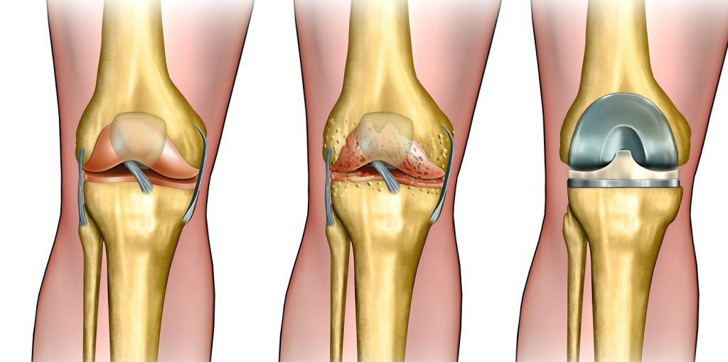 Пример здорового колена, больного колена и эндопротезирования
