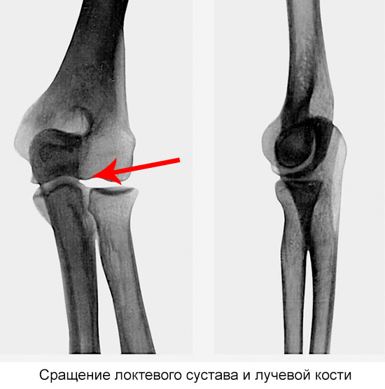 сращение костей локтевого сустава на рентгене