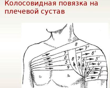Как наложить повязку на плечевой сустав, виды повязок на плечо