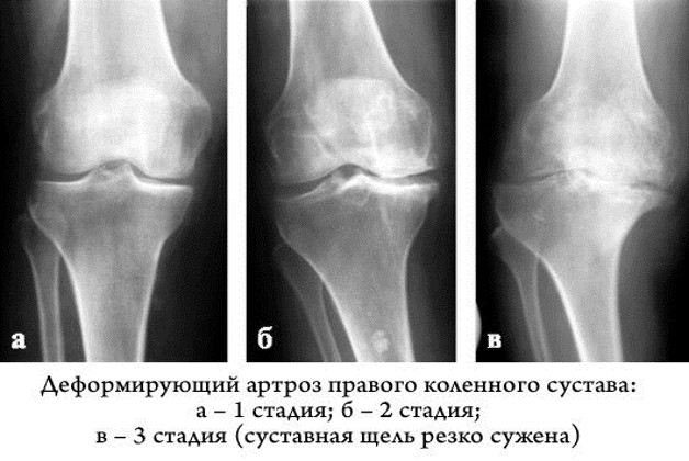 Рентгеновский снимок колена