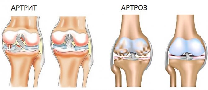 Артрозы и артритыстановятся причиной болей в ногах