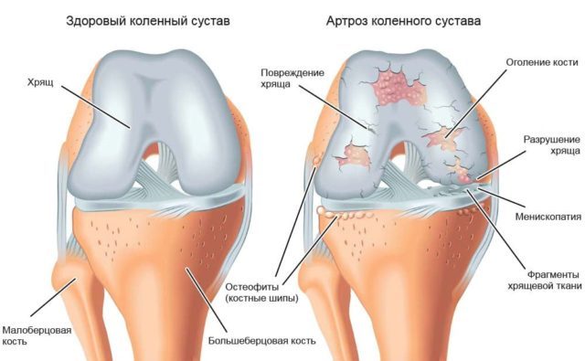 Гонартроз в зоне коленного сустава 3 степени – запущенная стадия патологии