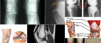 Лигаментоз колена – внешние характеристики патологии
