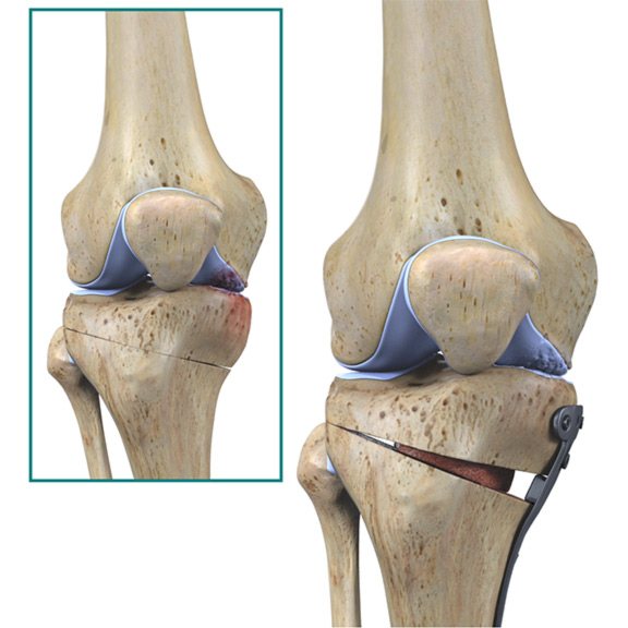 остеотомия колена
